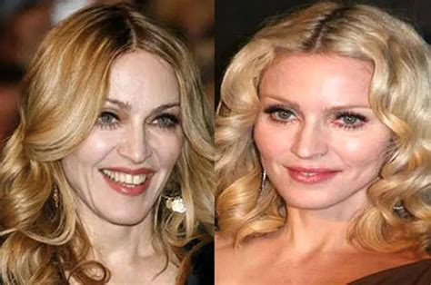 Madonna Facelift Plastic Surgery Before and After | Celebie