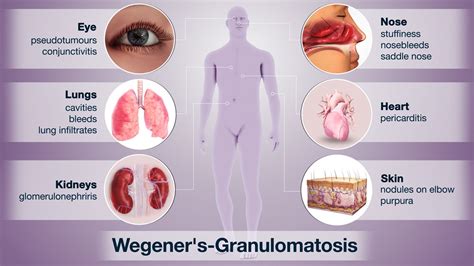 symptoms of nose cancer - LeetaroMiranda