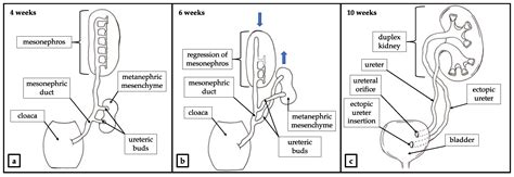 Ectopic Ureter