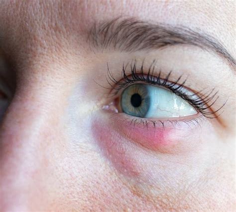 Stye Chalazion Causes Symptoms Stye Vs Chalazion Non - vrogue.co