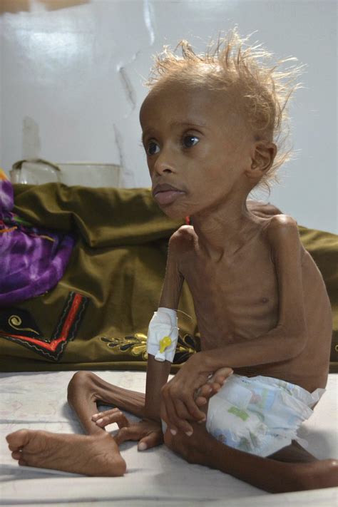 Starvation in YEMEN.