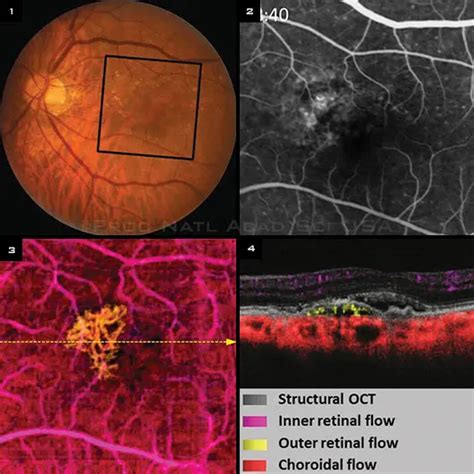 New Views of Retina With OCT Angiography - American Academy of ...