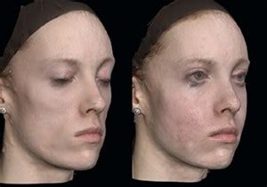 Lipodystrophy, Syndrome, Treatment, Symptoms