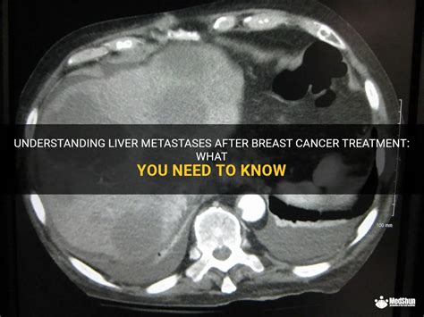 Understanding Liver Metastases After Breast Cancer Treatment: What You ...