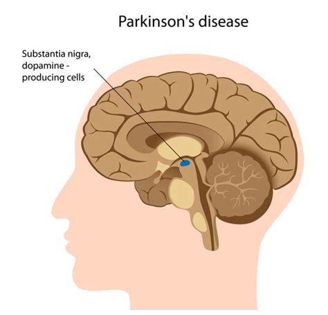 Parkinson's disease: MedlinePlus Genetics