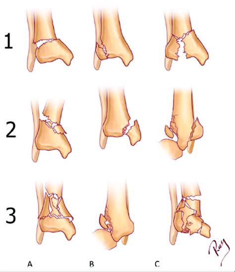 AO/OTA classification for end segment distal tibia fractures: (A)... | Download Scientific Diagram