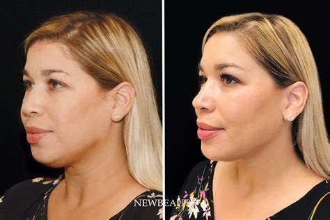 How CoolSculpting and Filler Gave My 40-Year-Old Face a Kardashian-Jenner Contour - NewBeauty