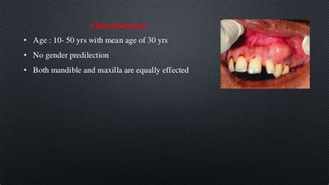 Odontogenic Myxoma