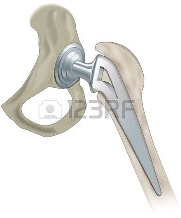 hip replacement clipart 20 free Cliparts | Download images on ...