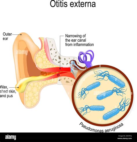 Swimmer's ear. Otitis externa is inflammation of the ear canal ...