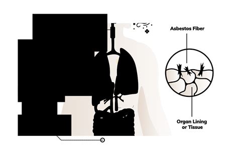 Asbestos Cancer | What Types Are Caused by Asbestos & How?