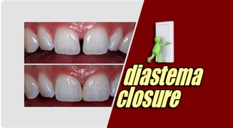 Diastema Closure – Richardson's Plastic Surgery Hospitals