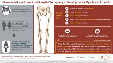 leg length discrepancy Archives - OrthoBuzz