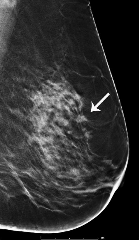 Breast Cancer Screening with 3D Mammography or Tomosynthesis - Radiology & Imaging, MA, CT