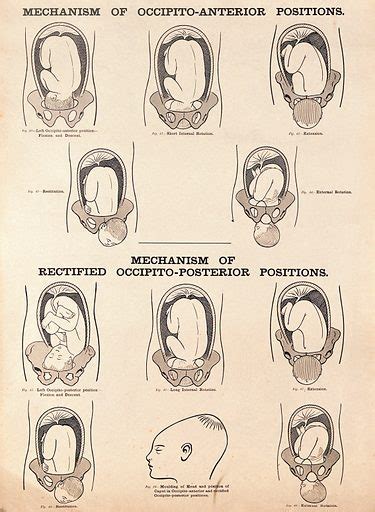 Mechanisms of occipito-anterior positions and rectified … free public domain image | Look and Learn