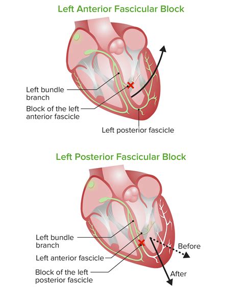 Bundle Branch and Fascicular Blocks | Concise Medical Knowledge