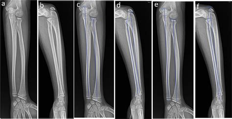 Frontiers | Characteristics of the length of the radius and ulna in children