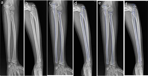 Frontiers | Characteristics of the length of the radius and ulna in children