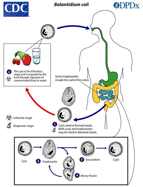 Balantidiasis