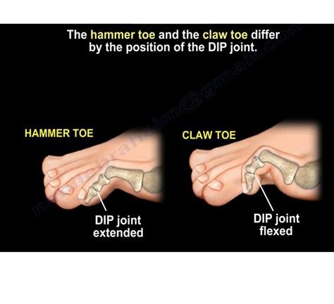 Claw toe and Hammer toe — OrthopaedicPrinciples.com