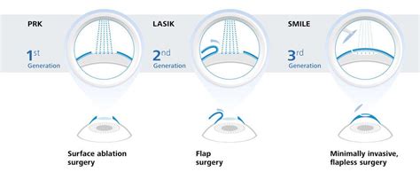 SMILE, LASIK or PRK Surgery: Which is Best?