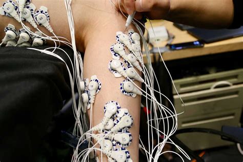 A new type of amputation surgery may enable better control of prosthetic limbs