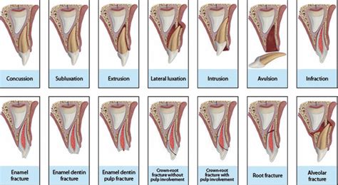 Dentoalveolar Fractures