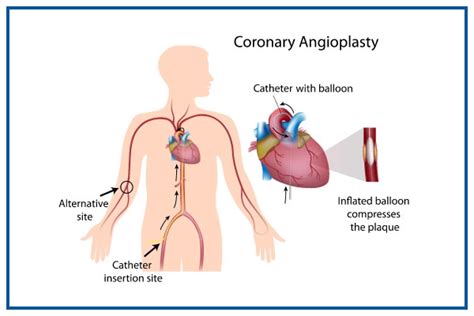 Best Coronary Angioplasty and Stents Insertion Doctors in India