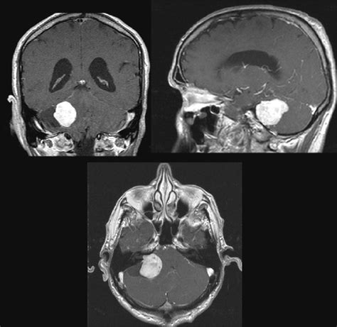 Acoustic Neuroma MRI Images