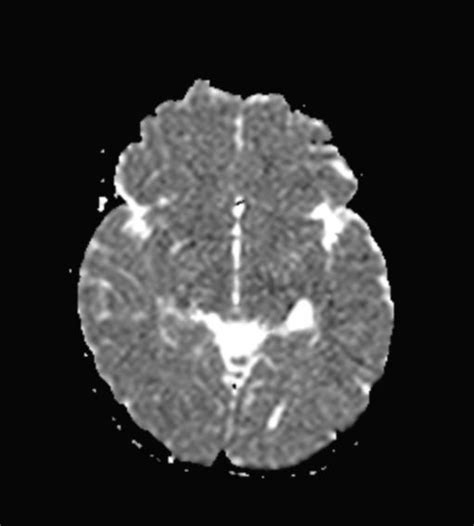 Choroidal fissure cyst | Image | Radiopaedia.org