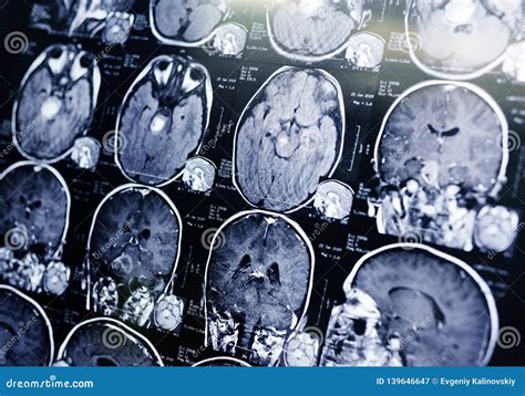 MRI Scan of a Patient with a Tumor in the Brain Stem. Stock Image ...