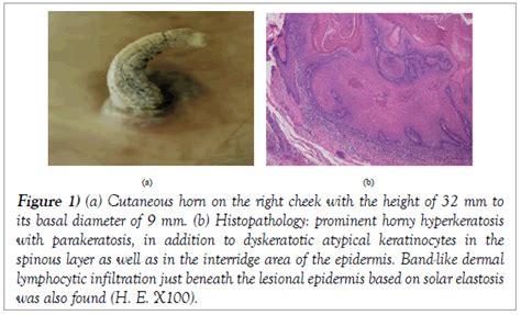 Actinic Keratosis Horn