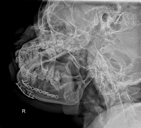 1 Complex Mandibular Fracture Royalty-Free Images, Stock Photos ...