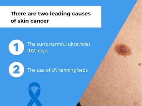 What Does the Beginning of Skin Cancer Look Like? – Associated ...