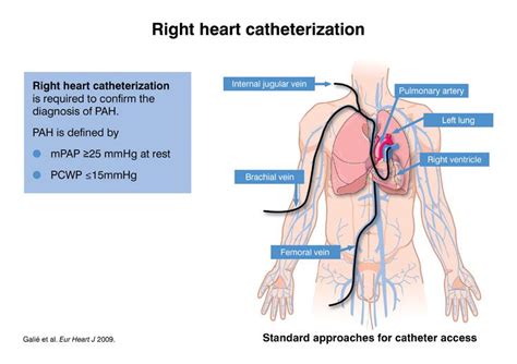 right heart catheterization - Google Search | Heart catheterization, Pulmonary, Medical ...