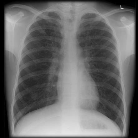 Cystic Fibrosis Lungs