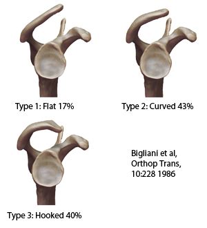 Acromion Classifications | ShoulderDoc