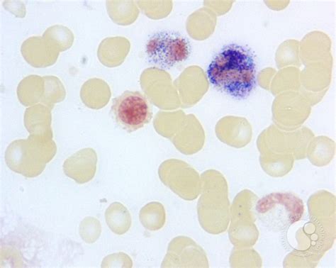 Leukocyte Alkaline Phosphatase Scoring - 6.