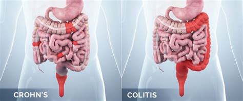 Crohn's Disease Guidelines and Management Tips