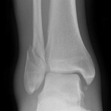 Weber B fracture and ORIF Ankle Fracture, Xray Technician, Med Surg ...