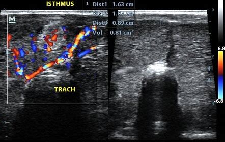 Toxic multinodular goitre | Radiology Case | Radiopaedia.org