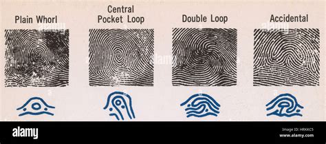 Ulnar Loop Vs Radial Loop Fingerprint