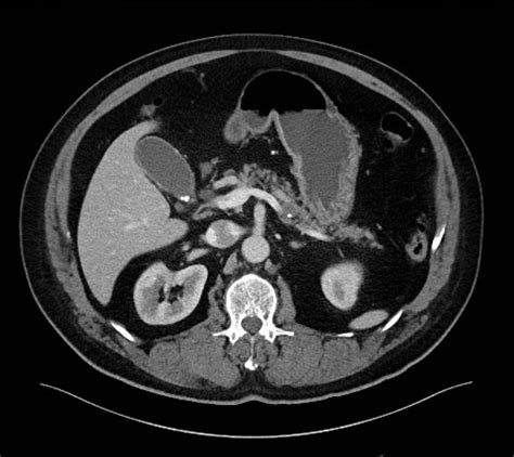 Transpyloric plane CT Diagram | Quizlet