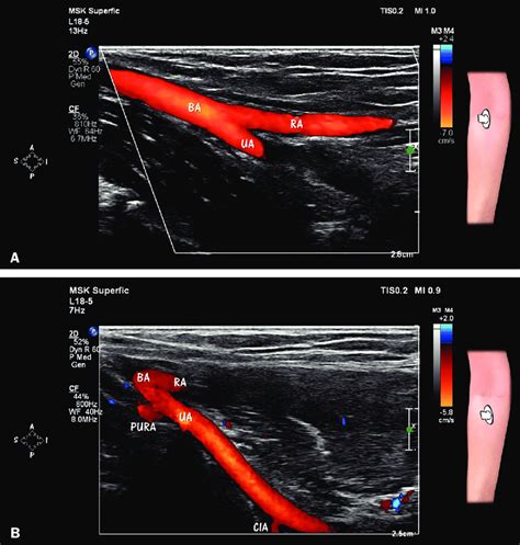 HRUS with Doppler, showing the bifurcation of the brachial artery (BA)... | Download Scientific ...