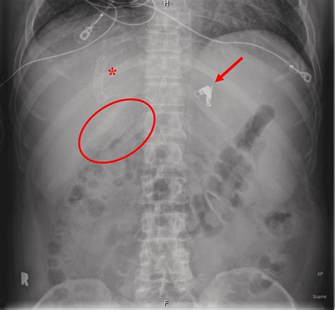 Cureus | CT Imaging Findings of Porcelain Gallbladder and Epiploic ...