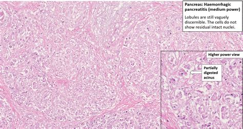 Pancreas – Acute Haemorrhagic Pancreatitis – NUS Pathweb :: NUS Pathweb