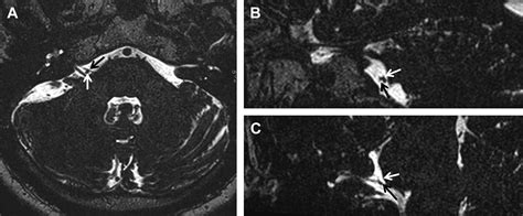 Imaging of Vascular Compression Syndromes - Radiologic Clinics