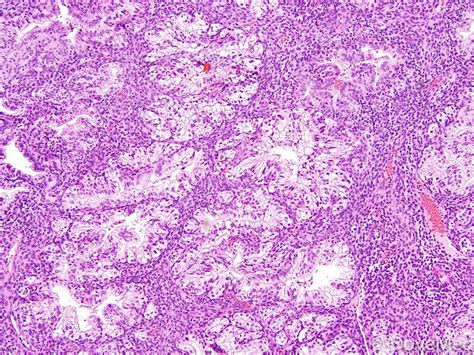 Clear Cell Carcinoma of Endometrium