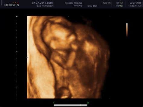 Gender reveal ultrasound 16 weeks | BabyCenter