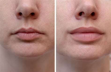 4 Most Popular Lip Fillers that Make Your Pout Last Really Long